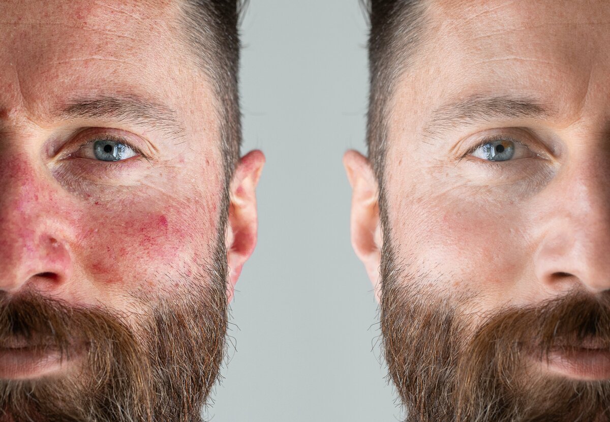 blog.rosaceainfo.de Rosacea Blog